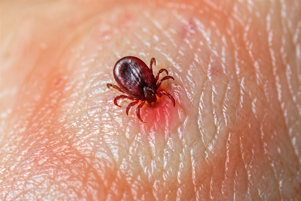 Close-up of a tick on human skin, illustrating a tick bite and its impact on health awareness.