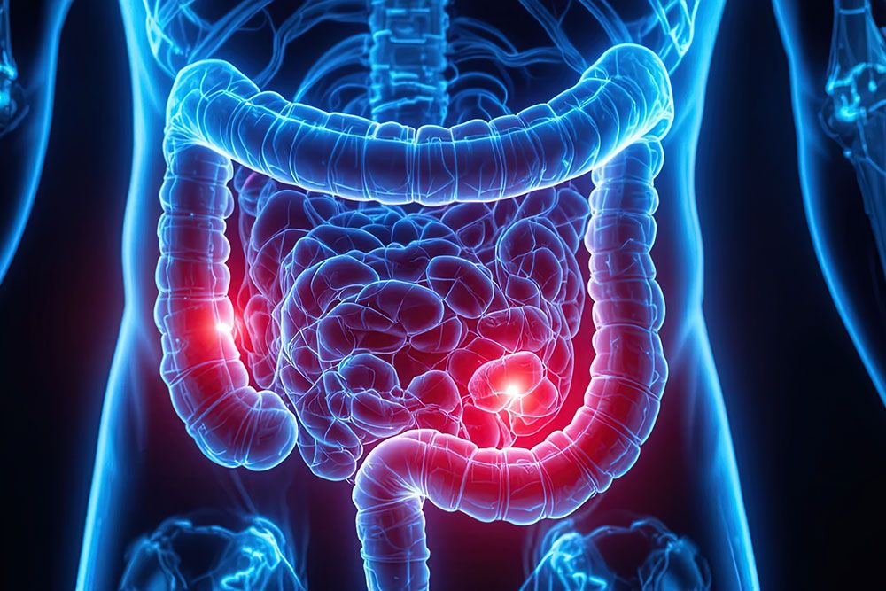 X-ray view of human intestines highlighting inflammation in the colon, indicating digestive health issue.